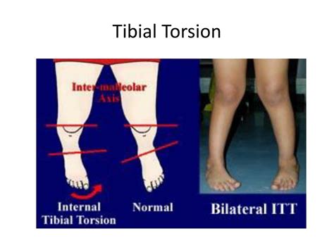 tibial torsion test normal range|internal tibial torsion in adults.